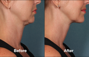 photos of a woman before and after a Kybella procedure