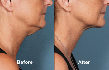 photos of a woman before and after a Kybella procedure