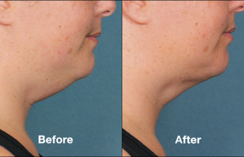 photos of a woman before and after a Kybella procedure