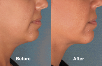 photos of a woman before and after a Kybella procedure