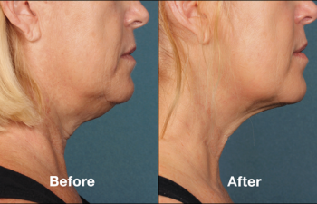 photos of a woman before and after a Kybella procedure