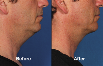 photos of a man before and after a Kybella procedure
