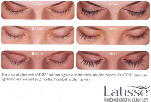 Before and after photos of a womans face. The onset of effect with LATISSE solution is gradual. In the clinical trial, the majority of LATISSE users saw significant improvement by 2 months. Individual results may vary.