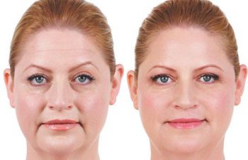 Juvederm® XC treatment - before and 2 weeks after treatment for marionette lines, parentheses lines, corner lines and vertical lip lines.
