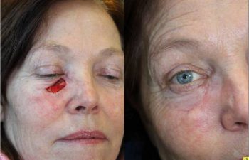 Eyelid reconstruction from skin cancer - 55 year old female 1 month post op following lower eyelid reconstruction from skin cancer