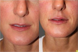 Juvederm Lip Augmentation - 32 yo female 2 weeks following juvederm lip augmentation.