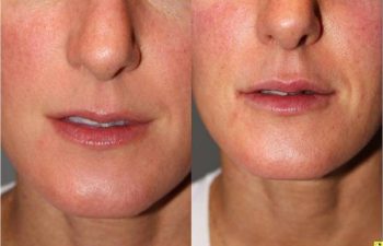 Juvederm Lip Augmentation - 32 yo female 2 weeks following juvederm lip augmentation.