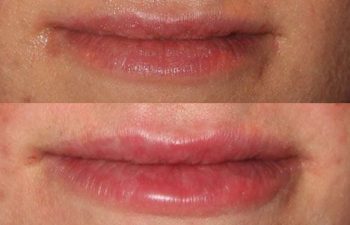 Juvederm Lip Augmentation - juvederm lip injection using the bruise free cannula injection technique.