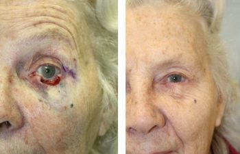Lower eyelid defect - Full thickness subtotal lower eyelid defect after Mohs surgery, requiring a Tenzel rotation advancement flap reconstruction.