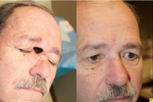 Nasal sidewall defect - 61 year old male with a large combination canthal, eyelid, nasal sidewall defect following Mohs surgery requiring a glabellar flap reconstruction.