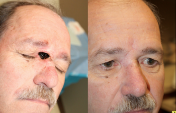 Nasal sidewall defect - 61 year old male with a large combination canthal, eyelid, nasal sidewall defect following Mohs surgery requiring a glabellar flap reconstruction.
