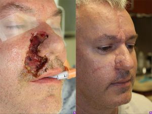 Nose, lip, and cheek skin cancer reconstruction - 48 year old male 3 months post op from a complex Mohs reconstruction of the lip, nose, and cheek.