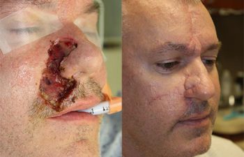 Nose, lip, and cheek skin cancer reconstruction - 48 year old male 3 months post op from a complex Mohs reconstruction of the lip, nose, and cheek.