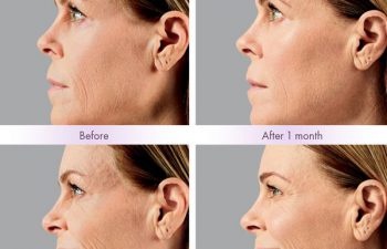 Juvederm Voluma® XC Treatment - Juvederm Voluma® XC was injected into the zygomatic arch, anteromedial cheek, and submalar region.