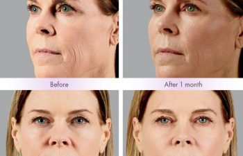 Juvederm Voluma® XC Treatment - Juvederm Voluma® XC was injected into the zygomatic arch, anteromedial cheek, and submalar region.