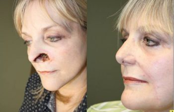 Before & After Large nasal ala/sidewall defect - 60 year old female with very large nasal ala/sidewall defect following Mohs surgery, requiring internal nasal lining flap, auricular cartilage graft, and a two stage cheek interpolation flap reconstruction.