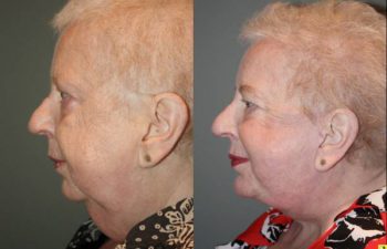 Facelift/Necklift with Chin Implant - 66 year old female 3 months following a facelift/necklift with chin implant.