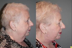 Before & After Facelift/Necklift with Chin Implant - 66 year old female 3 months following a facelift/necklift with chin implant.