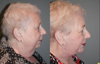 Before & After Facelift/Necklift with Chin Implant - 66 year old female 3 months following a facelift/necklift with chin implant.