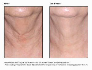 photos of skin before and after 8 weeks of using Nectifim twice daily, AM and PM. Results may vary. No other products or treatments were used. Photos courtesy of Victoria Cirillo-Hyland, MD and Collen Witmer Spa Director, Cirillo Cosmetic Dermatology Spa, Bryn Mawr, PA.
