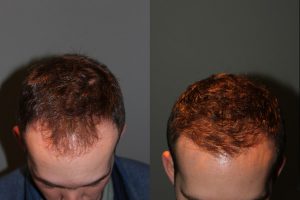 28 year old male one year postop from a Neograft FUE frontal hair transplant restoration procedure using 1500 grafts. - View 1 -