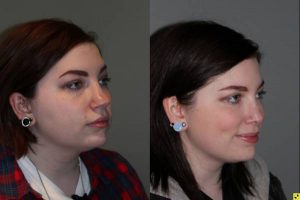 - 26 year old female 5 months following kybella injections to the double chin and rhinoplasty for a large, over projected, bulbous nasal tip