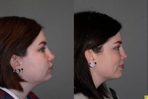 - 26 year old female 5 months following kybella injections to the double chin and rhinoplasty for a large, over projected, bulbous nasal tip