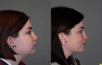 Rhinoplasty - 26 year old female 6 months following rhinoplasty for a large, over projected bulbous nasal tip and kybella injections for the double chin