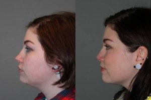 Rhinoplasty - 26 year old female 6 months following rhinoplasty for a large, over projected bulbous nasal tip and kybella injections for the double chin