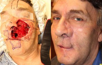 60 year old male with recurrent skin cancer - and a resultant complex full thickness nostril and upper lip deffect as well as large cheek and nasal sidewall defect....3 months post abbe lip replacement flap, forehead flap, and cervicofacial flap reconstruction.