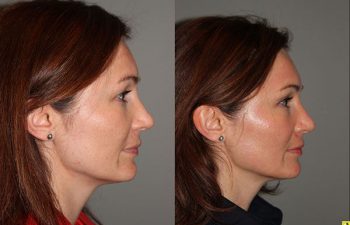 Pearl Laser Skin Resurfacing - 38 year old female 1 week post op from a Pearl Laser Skin Resurfacing procedure to reduce moderate wrinkles and brown pigmentation.
