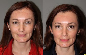 Pearl Laser Skin Resurfacing - 38 year old female 1 week post op from a Pearl Laser Skin Resurfacing procedure to reduce moderate wrinkles and brown pigmentation.