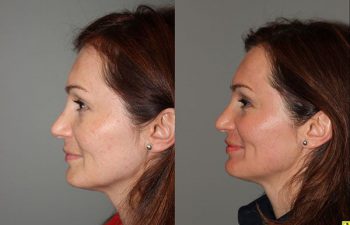 Pearl Laser Skin Resurfacing - 38 year old female 1 week post op from a Pearl Laser Skin Resurfacing procedure to reduce moderate wrinkles and brown pigmentation.