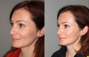 Pearl Laser Skin Resurfacing - 38 year old female 1 week post op from a Pearl Laser Skin Resurfacing procedure to reduce moderate wrinkles and brown pigmentation.