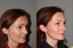 Pearl Laser Skin Resurfacing - 38 year old female 1 week post op from a Pearl Laser Skin Resurfacing procedure to reduce moderate wrinkles and brown pigmentation.