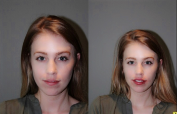 Lip Injections - 27 year old female lip augmentation with Juvederm using Dr. Stong's bruise-free, no downtime microcannula technique.