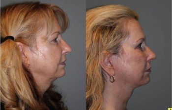 Upper Blepharoplasty & Mini Deep Plane Facelift - 54 year old female upper blepharoplasty and mini deep plane facelift 3.5 mos post op