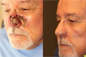 Skin Cancer Reconstruction - 75 year old male 4 month post op paramedian forehead flap, ear cartilage graft, and cheek advancement flap skin caner reconstruction.