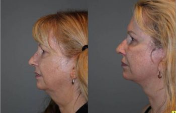 Upper Blepharoplasty & Mini Deep Plane Facelift - 54 year old female upper blepharoplasty and mini deep plane facelift 3.5 mos post op