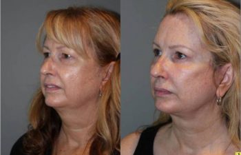 Upper Blepharoplasty & Mini Deep Plane Facelift - 54 year old female upper blepharoplasty and mini deep plane facelift 3.5 mos post op