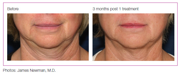 graphic showing the difference in the skin after 3 months of treatment. photo by james newman, m.d.