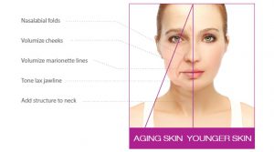 graphic showing the difference in nasalabial folds, volumize cheecks, volumize marionette lines, tone lax jawline and added structure to the neck in young and aging skin