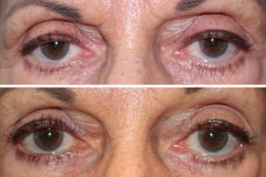 Before & After Upper eyelid ptosis repair - 68 year old female 5 months following a bilateral upper eyelid ptosis repair to raise the position of the upper eyelid, creating a more vibrant, youthful appearance to the eyes.
