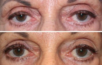 Before & After Upper eyelid ptosis repair - 68 year old female 5 months following a bilateral upper eyelid ptosis repair to raise the position of the upper eyelid, creating a more vibrant, youthful appearance to the eyes.