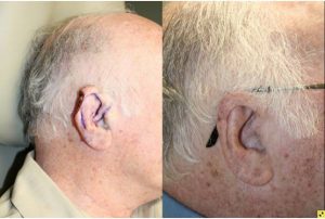 Before & After Cartilage defect of the helical rim - 77 year old male 3 months post op with skin and cartilage defect of the helical rim requiring V to Y advancement flap reconstruction to repair defect.