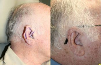 Cartilage defect of the helical rim - 77 year old male 3 months post op with skin and cartilage defect of the helical rim requiring V to Y advancement flap reconstruction to repair defect.