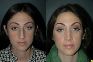 Cosmetic Rhinoplasty - Cosmetic Rhinoplasty performed on 27yo female for bridge/hump reduction and tip refinement.