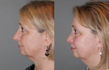 Cosmetic Rhinoplasty - Cosmetic Rhinoplasty performed on 59yo female to reduce the over all size, the bridge or hump, and to elevate and refine the tip.