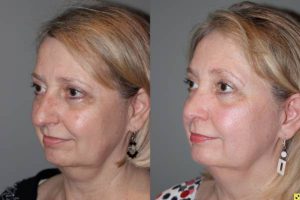 Cosmetic Rhinoplasty - Cosmetic Rhinoplasty performed on 59yo female to reduce the over all size, the bridge or hump, and to elevate and refine the tip.