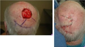 Scalp Reconstruction - Scalp Reconstruction performed for large post-Mohs defects using a multi-flap reconstruction technique.